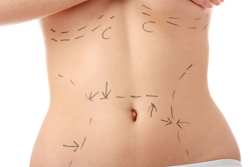 Fat Suction (Liposuction)
